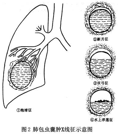 作為含液囊腫,立位透視吸氣時膈肌下降,頭,足徑稍增加,呼氣膈肌