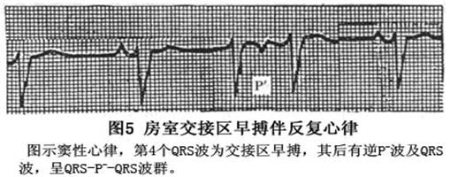 房室交接区性期前收缩介绍 就医120 为患者找