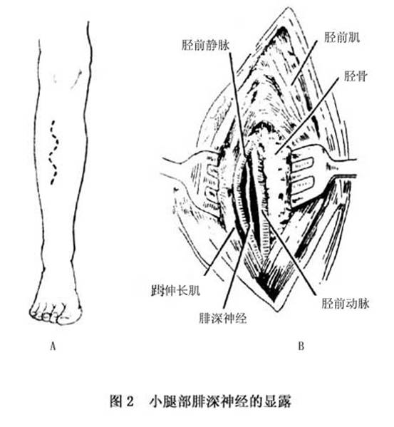 ①切口:自股后腓骨头上约8cm处,沿股二头肌内缘,由下外经腓骨头