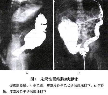 侧位显示最清,故一般仅摄带肛门标记的侧位x线片,但痉挛段达乙状结肠