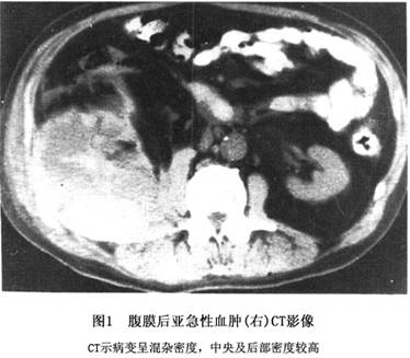 腹膜后血肿图片图片