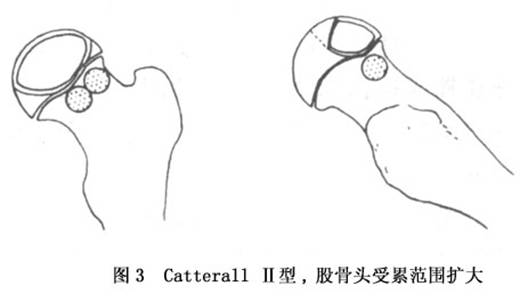 股骨头骨骺骨软骨病