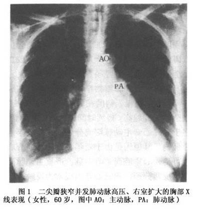 老年人風溼性心臟病