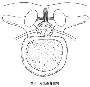 脊柱裂