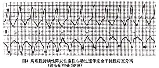 近50%的室性心动过速病例发作时呈现完全性干扰性房室脱节;在部分病例