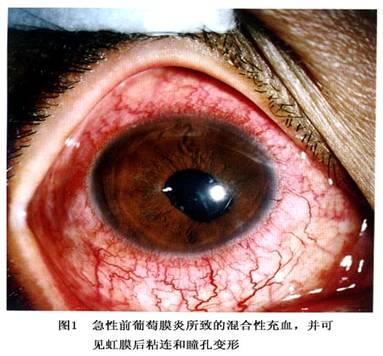 前葡萄膜炎\/前色素层炎\/前眼色素层炎-疾病概述-疾病专区-微医(挂号网)