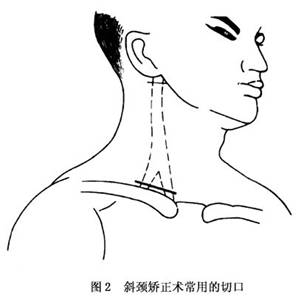 先天性斜頸