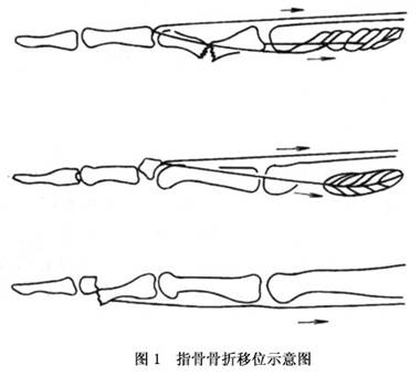 指骨骨折的疾病介绍 挂号网