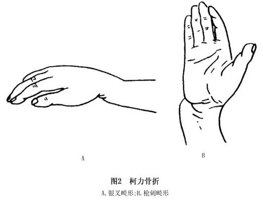 桡骨远端骨折