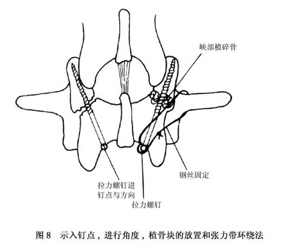 腰部峡部崩裂和脊椎滑脱