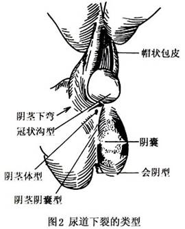 尿道下裂症状男孩图片