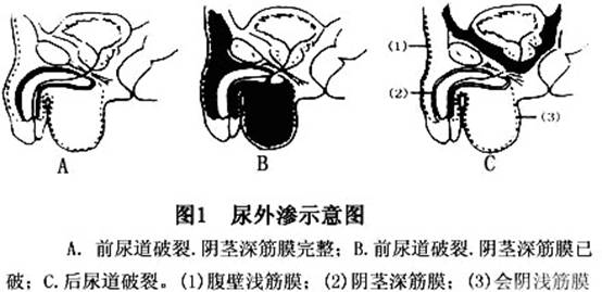 膀胱损伤示意图图片