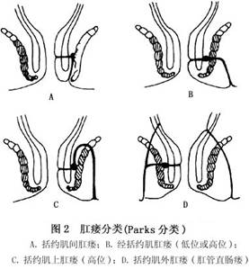 目前多按瘘管与括约肌的关系将肛瘘分为4类(图2)