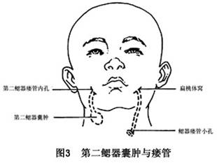 其外孔与第2腮器瘘管的外孔的位置基本一样,但内孔是在甲状舌骨膜进入