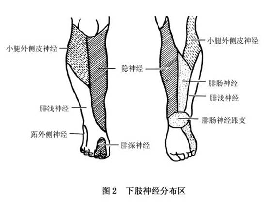 坐骨神經損傷