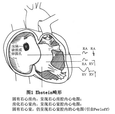 三尖瓣下移畸形