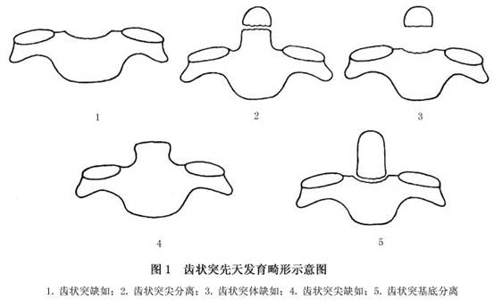 单纯性寰枢椎脱位