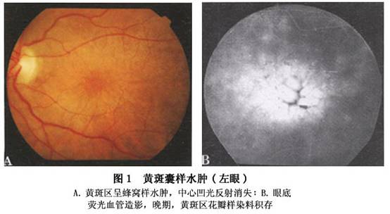黄斑囊样水肿