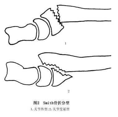 史密斯骨折