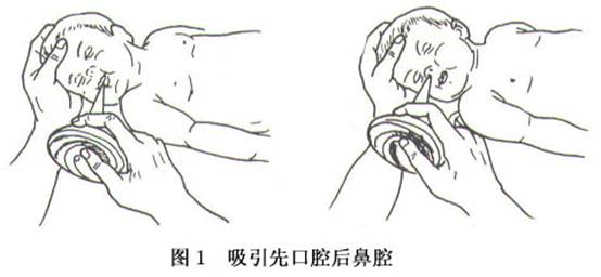 新生儿窒息