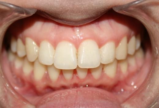 图示:牙齿拥挤lh魔线正畸戴上矫正托槽后(左)及10个月牙齿矫正结束后