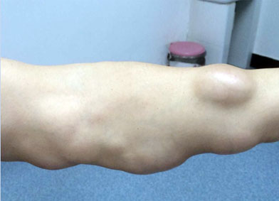 手臂肿瘤图片