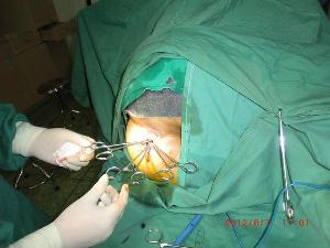 肛周脓肿手术挂线图片图片