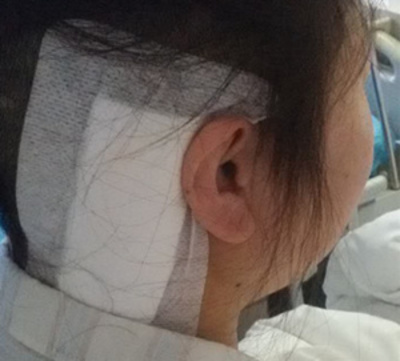 周女士刚做完手术,耳后被包扎的伤口