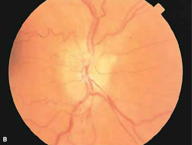 非动脉炎性前部缺血性视神经病变