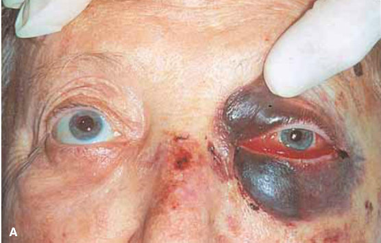 (2)视神经管骨折,视神经管或眶尖血肿压迫造成的眶间隔综合征,眼科