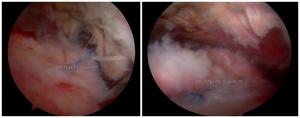 鏡下徹底清除鈣化灶後,見岡上肌腱足印區裸露,岡上肌腱部分