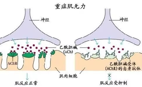 青少年型重症肌無力是指發病年齡在0-19歲的重症肌無力,包括嬰兒,兒童