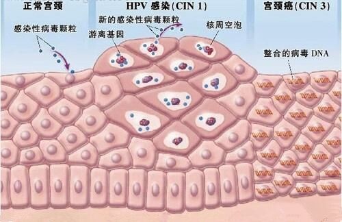 tc丅檢查正常,陰道鏡顯示薄醋白,碘不著色是咋回事而柱狀上皮,未成熟