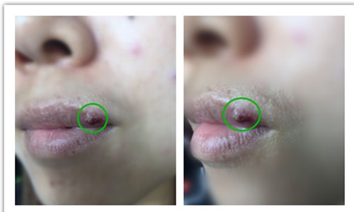 很多人认为,"烂嘴角"是秋燥引起,属于中医所说的阳邪,自认为是"上火"