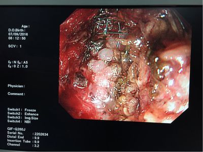 食管癌支架阻塞,第二次支架植入开通食管