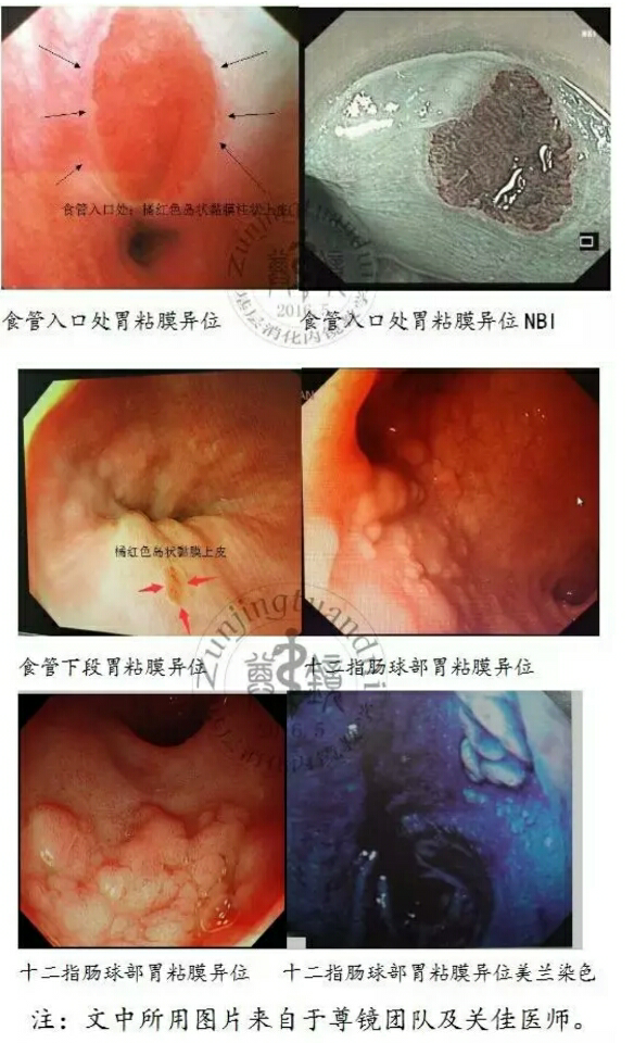 食管胃粘膜异位症图片