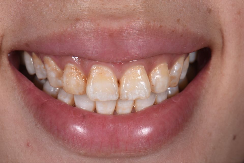 患者中度的氟斑牙,颜色异常,考虑漂白等技术效果不理想,选择了