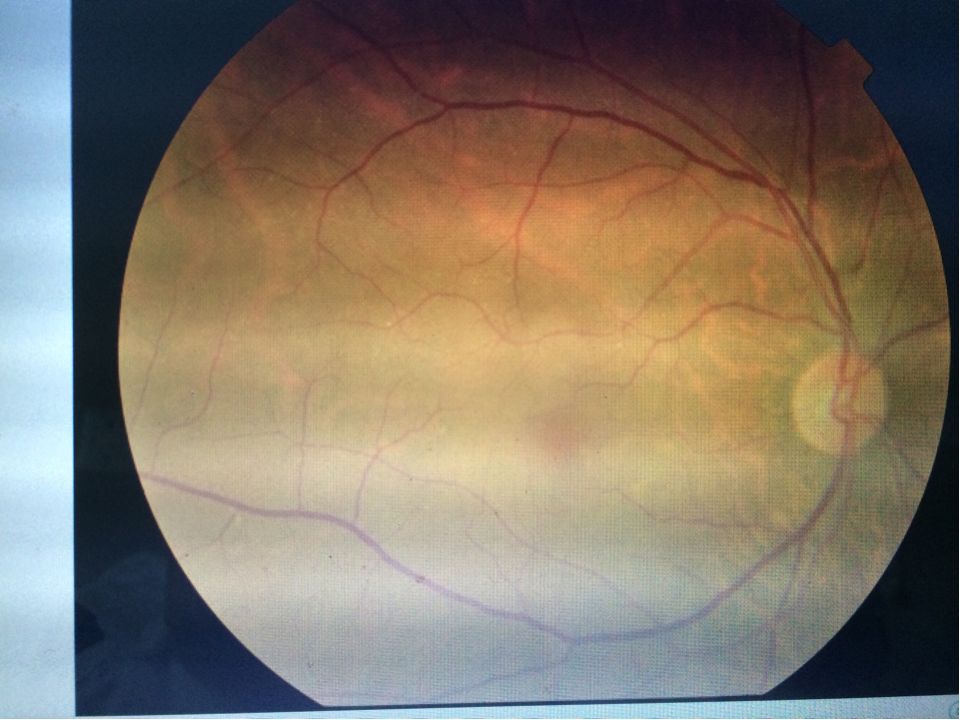 眼前固定黑影遮挡之三:视网膜脱离