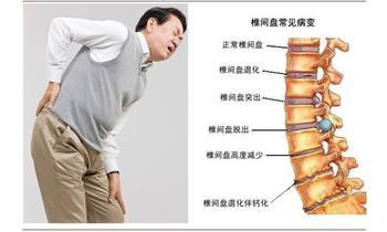 腰椎间盘突出症的诊断与治疗