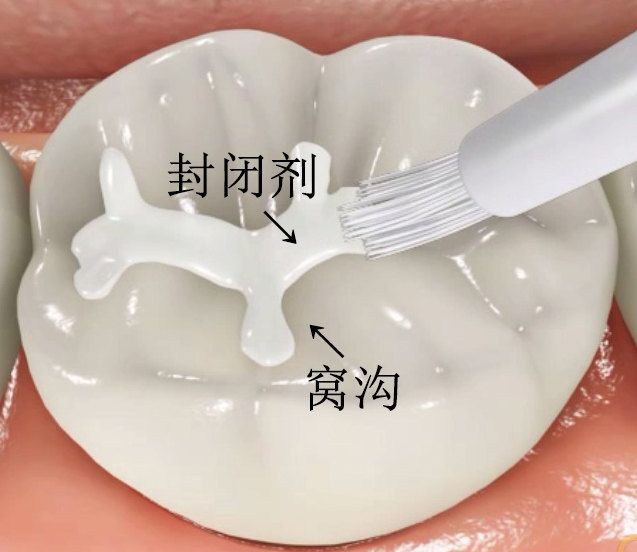 窝沟封闭,对于乳牙和恒牙的龋齿预防都有很好的效果.