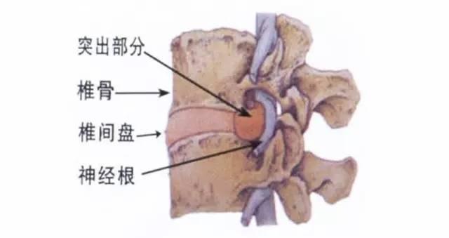 避免腰间盘突出，这6种运动不能练！